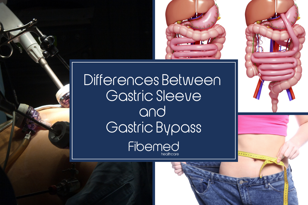 Differences Between Gastric Sleeve and Gastric Bypass – Fibemed Healthcare